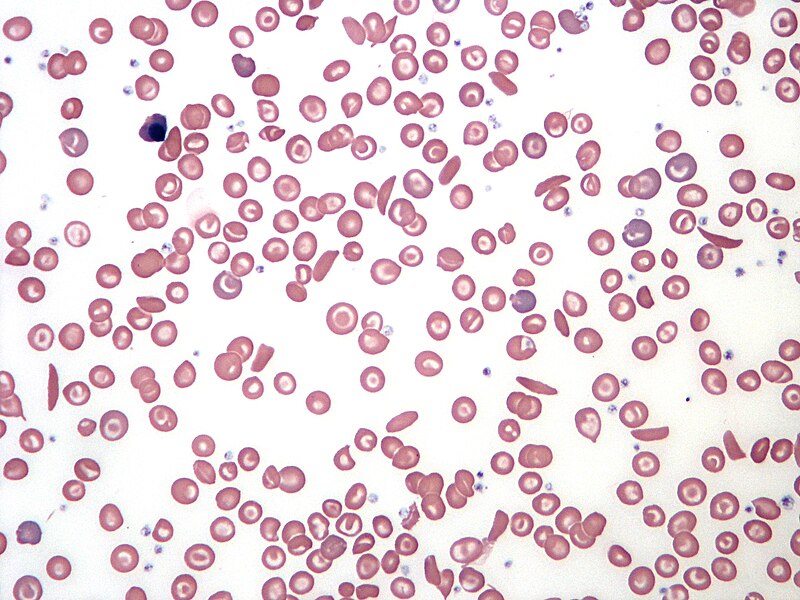Sickle_Cell_Blood_Smear.JPG